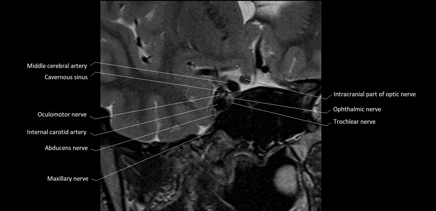 MRI Orbit coronal cross sectional anatomy image 20.webp
